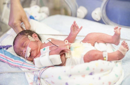 Premature newborn baby in a neonatal intensive care unit (NICU), lying on a blanket with monitoring equipment and tubes attached.