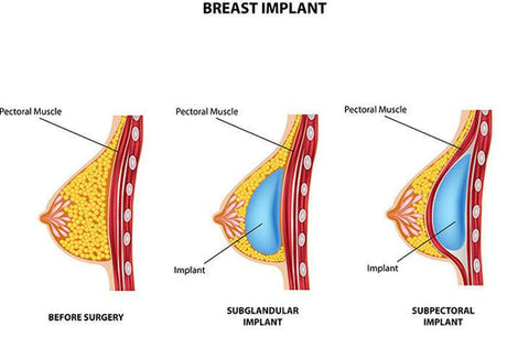 Is It Dangerous to Breastfeed with Breast Implants?