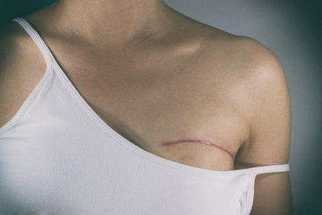 Close-up of a person's chest with a surgical scar under the breast, often associated with breast cancer surgery, wearing a white tank top with one strap off the shoulder.